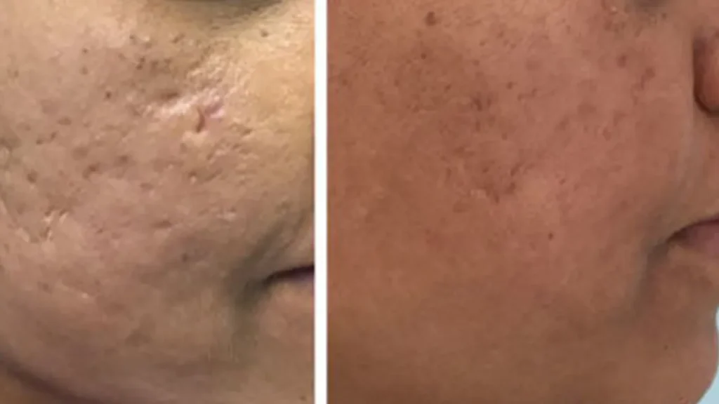 acne-treatments-img1