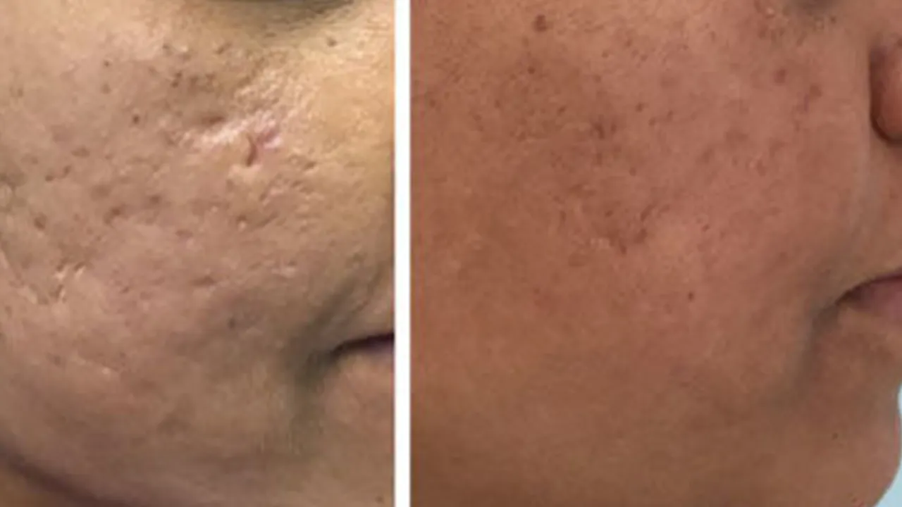 acne-treatments-img1