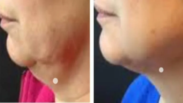 do-fat-dissolving-injections-aqualyx-work-img1