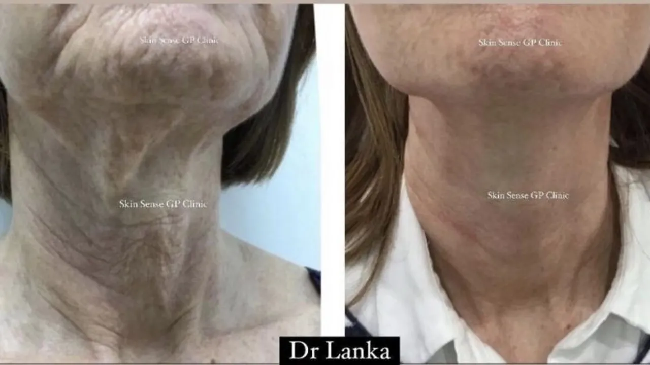 hifu-a-miracle-treatment-img1