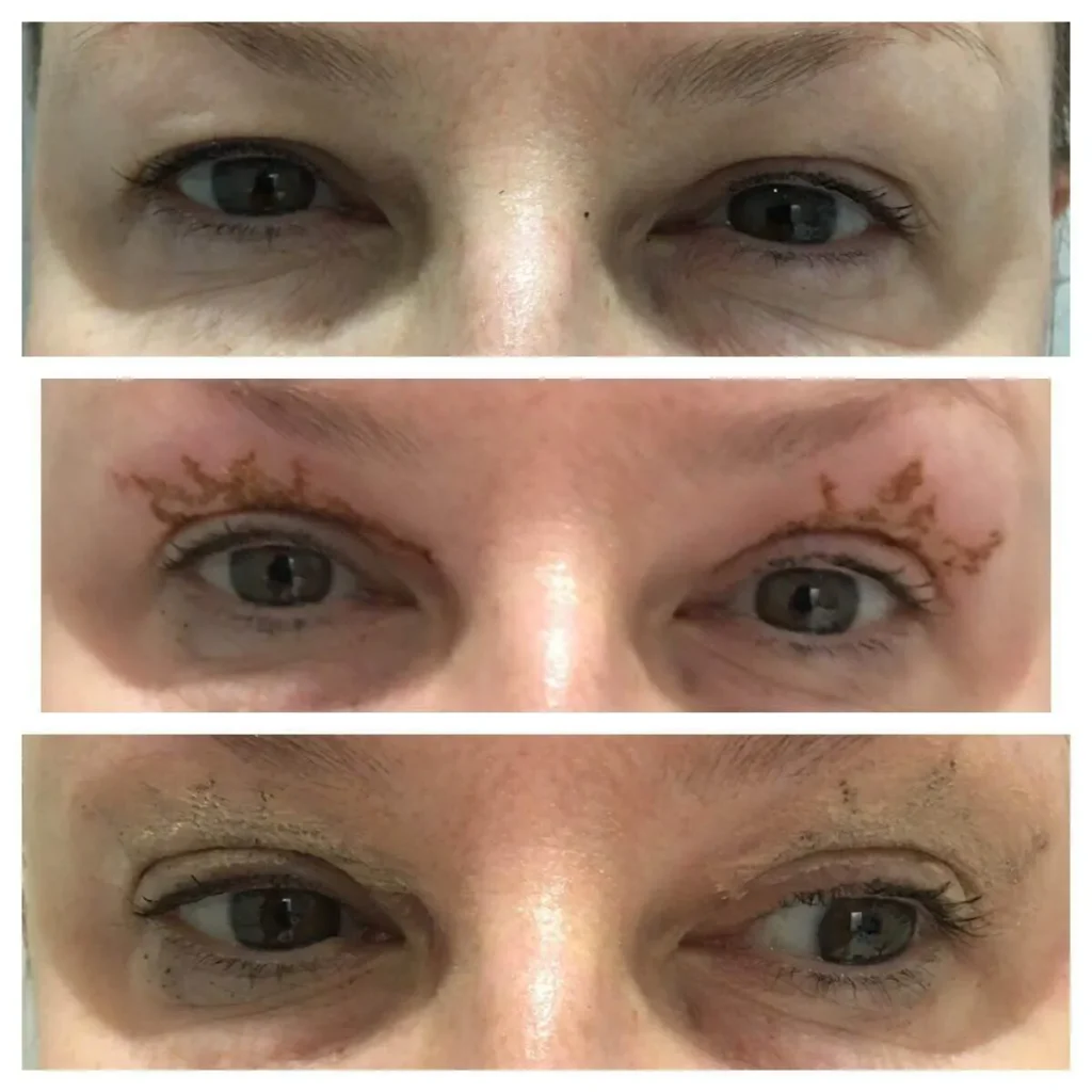 Blepharoplasty-media-3.webp