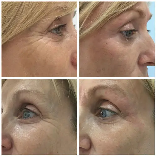 Blepharoplasty-media-5