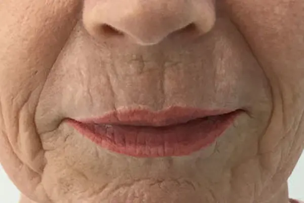 anti-wrinkles-injections-img1