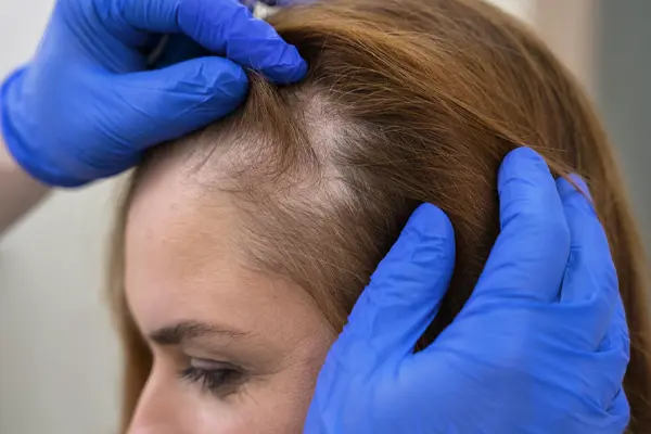 hair-restoration-gallery1