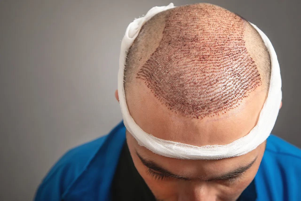 hair transplant