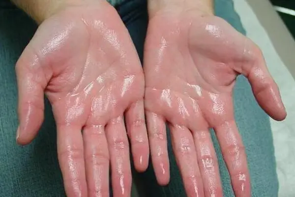 hyperhidrosis-treatment-gallery1