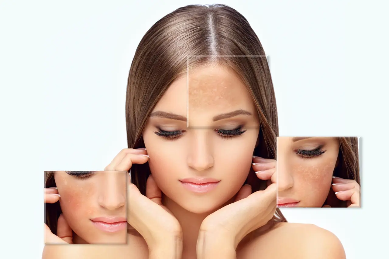 hyperpigmentation-treatment