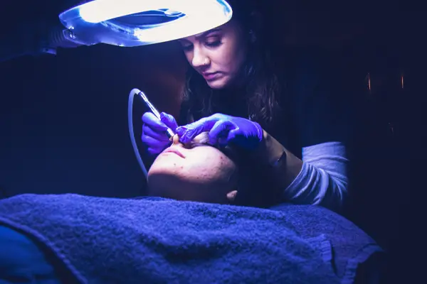 microdermabrasion-gallery1