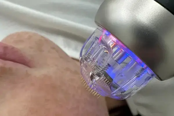 rf-microneedling-gallery1