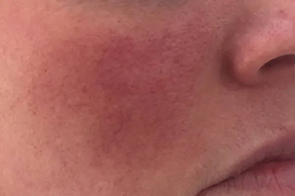 rosacea-treatment