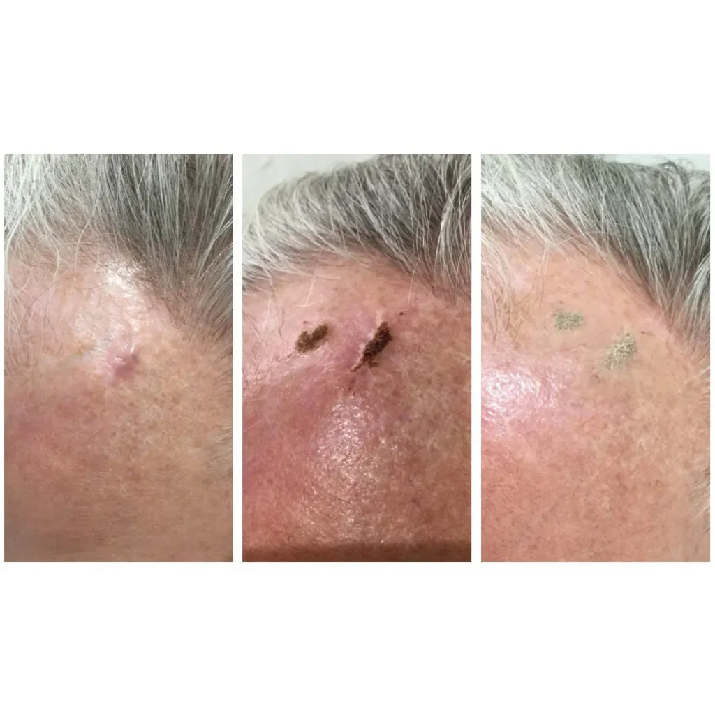 soft-surgery-plexr-1