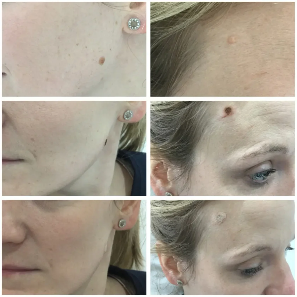 soft-surgery-plexr-4