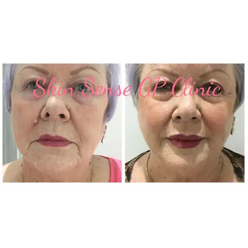 soft-surgery-plexr-7