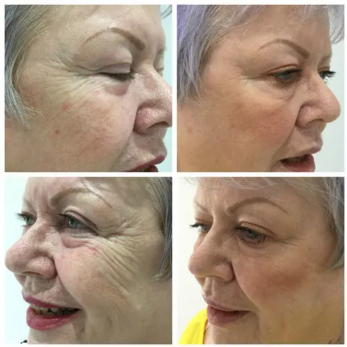 soft-surgery-plexr-8