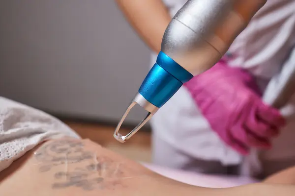 tattoo-removal-gallery1