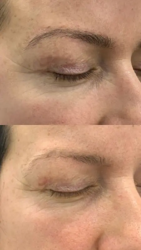 co2-laser-resurfacing-gallery1