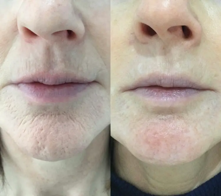 co2-laser-resurfacing-gallery2