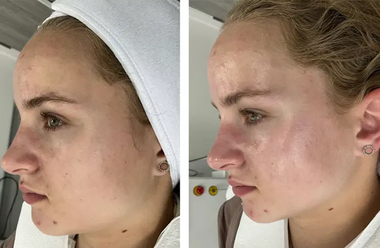 hydro2-facial-gallery1