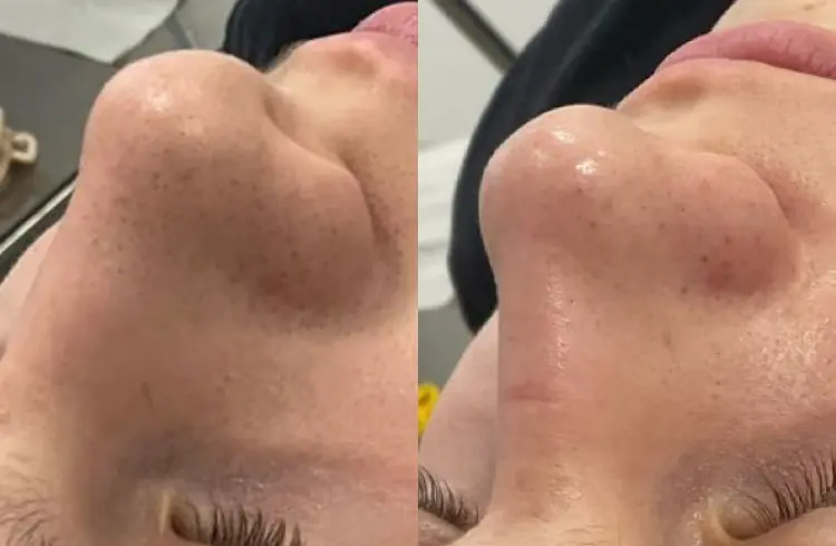 hydro2-facial-gallery2