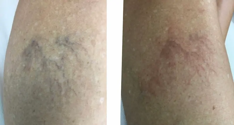 thread-veins-gallery1