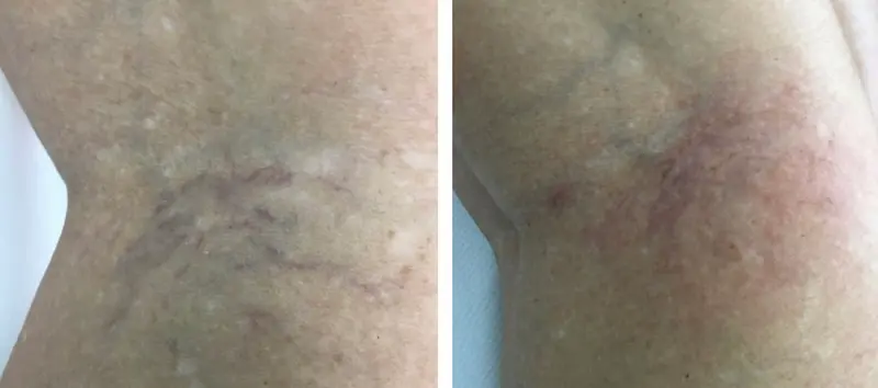 thread-veins-gallery2